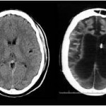 A scan of Terri Schiavo's brain, showing the extent of damage on the right
